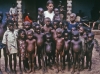 kwashiorkor sendromu / #288096