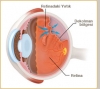 retina dekolmanı / #343240